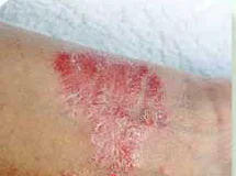皮膚問題示意